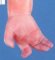 Hand oligodactyly