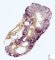 Fetal obstructive kidney (22 weeks)