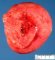 Pulmonary giant cystic chondroid hamartoma