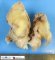 Localized neurofibroma in neurofibromatosis type 1