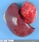Pancreatic solid pseudopapillary tumor (with spleen)
