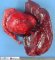 Pancreatic solid pseudopapillary tumor (with spleen)