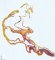 Splenic multilocular mesothelial cysts