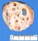 Testicular mixed germ cell tumor