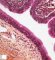 Ciliated epithelium in immature ovarian teratoma (6 years)
