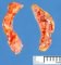 Adrenal hemorrhages in neonatal cardiogenic shock