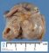 Colonic duplication in the ileocolic region. 1