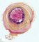 Cystic fibrosis: mucus plug in appendix