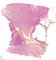 Cystic nephroma