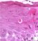 Apoptotic epithelial cell in esophageal GVHD