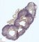 Fetal obstructive kidney 22 weeks