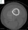 Femoral osteosarcoma (Case 12617)