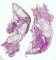 Achondrogenesis type 2 (case 10610)