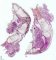 Achondrogenesis type 2