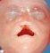 Facial dysmorphism in holoprosencephaly sequence (case 12063)