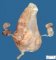 Fetus, 17 weeks. Urethral atresia and megacystis sequence