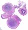 Appendiceal carcinoid tumor