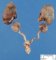 Bilateral normonephronic renal hypoplasia (bilateral simple renal (...)