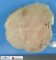 Fish flesh appearance - Clear cell sarcoma of the kidney