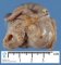 Colonic duplication (ileocecal junction)