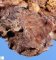 Colonic lymphangioma