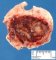 Cranial eosinophilic granuloma