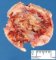 Cranial eosinophilic granuloma