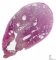 Endometrial polyp