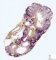 Fetal hydronephrosis (22 weeks)