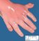 Hand post-axial polydactyly in Smith-Lemli-Opitz syndrome