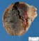 Testicular hemorrhagic necrosis in testicular torsion