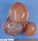 Mesenteric cystic lymphangioma