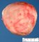 Necrobiotic subserosal uterine leiomyoma