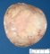 Necrobiotic subserosal uterine leiomyoma
