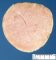 Necrobiotic subserosal uterine leiomyoma