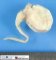 NF1-associated neurofibrosarcoma