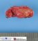 Paratesticular Leydig cell tumor