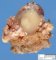 Cyst of the thyroglossal tract