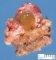 Cyst of the thyroglossal tract