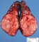 Thyroid papillary carcinoma