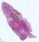 Pulmonary nodule in lymphomatoid granulomatosis