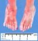 Post-axial polydactyly in Meckel syndrome