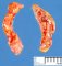 Adrenal hemorrhages in neonatal cardiogenic shock