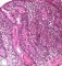 Intestinal cystic fibrosis with villous atrophy