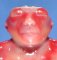 Anencephaly (fetus, 19 weeks)