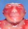 Anencephaly (fetus, 19 weeks)