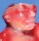 Anencephaly (fetus, 19 weeks)