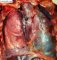 Hemopericardium after aortic root dissection