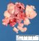Infantile fibrosarcoma