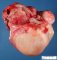 Intra-abdominal immature teratoma